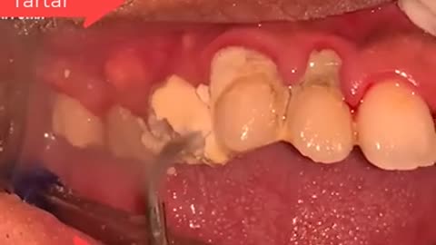 Tartar Dentist 2021 | Satisfying Dental-work