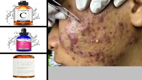 pimple popping video