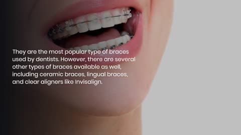6 Things You Need To Know Before Getting Dental Braces