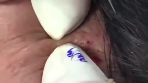 BLACKHEAD EXTRACTION #2 VERY SATISFYING!!