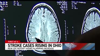 CDC reports alarming increase in stroke cases in Ohio