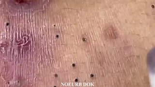 Popping Tons Of Blackheads