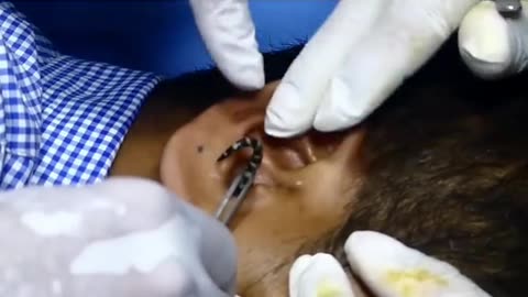 Horrifying bug removing from Ear