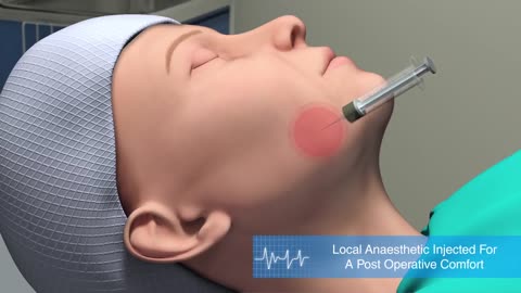 Facelift Procedure medical 3d animation