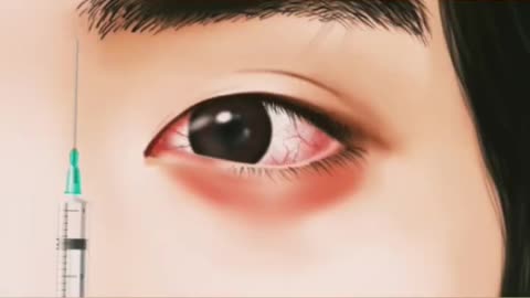ASMR 속눈썹에서 이가 제거 애니메이션 | 눈꺼풀의 거대 밀리아 치료 | Eyelash Lice Removal & Eyelid Acne Treatment | #Shorts