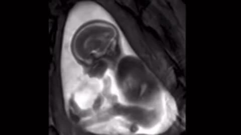 An MRI scan of a baby at 18 weeks. The size of a teaspoon but full of life. Have a listen.