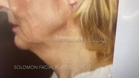 Deep Plane Facelift Before and After Results
