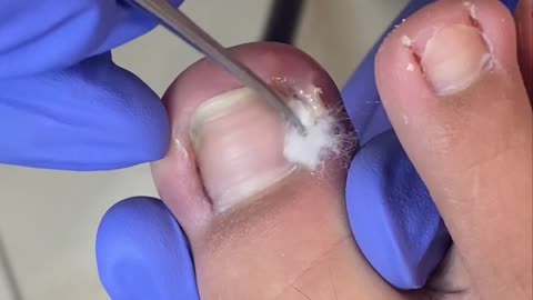 The most pus I've ever seen! Severe purulent inflammation of paronychia【Doctor Liu Pedicure】