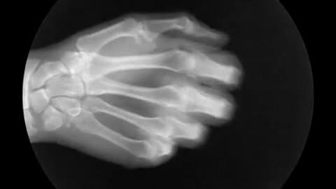 Hand Bones From X-ray View