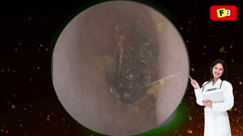 Ear Wax Removal PART 17