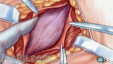 Hernia Repair Inguinal (Open) Surgery