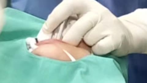 Removal of Foreign body in esophagus