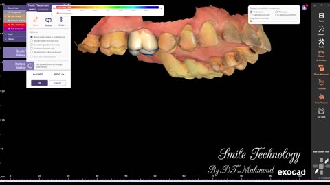 #design #naildesign #dental #dentaldesign #exocadexpert