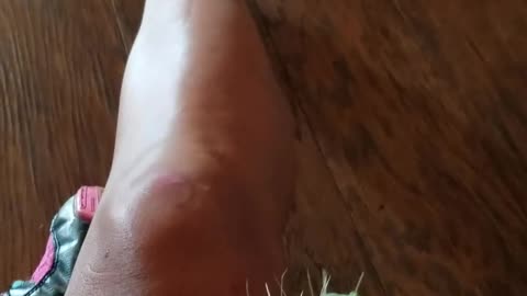 Spiky Cactus Stuck in Leg