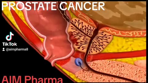 Prostate cancer animation #2023