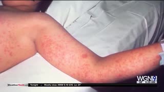 Despite Mass Jabs, Chicago Has An Illegal Alien Measles Crisis Worse Than Last 14 Years COMBINED