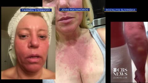 California community questions if fires caused "mystery rashes"