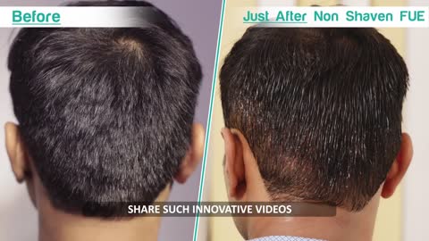 FIRST DIRECT NON SHAVEN FUE TRANSPLANT OF INDIA. COMPLETE PROCESS.