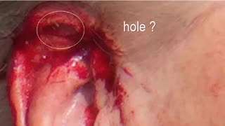 Trump's ear bullet hole