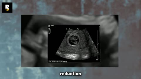 Babies Having Heart Attacks in the Womb?
