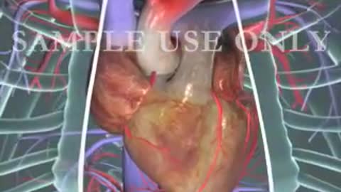Heart Bypass Surgery (CABG)
