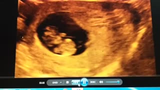 Baby ultrasound at 9 weeks