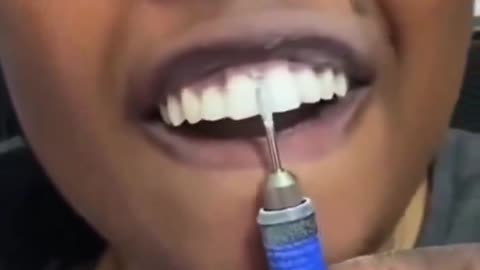 Filing Gap In Teeth