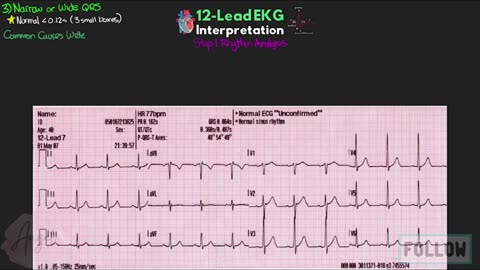 The SIMPLE Steps of 12-Lead EKG Interpretation - EXPLAINED CLEARLY!