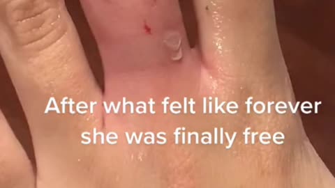 The Time A Girl got A Ring Stuck On Finger #shorts #Girls #ring