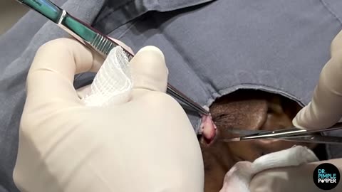 A Bear-y Good Cheek Cyst