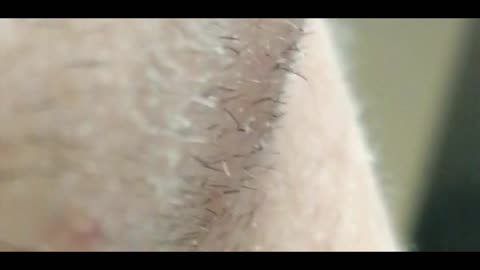 MUST SEE Jabs morgellons eggs skin shedding etc