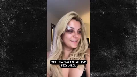 Bebe Rexha Shows Off Eye Injury After Getting Hit With Phone