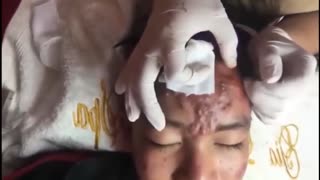 Deep Blackheads Removal from Cheeks and Nose Best Pimple Popping Videos