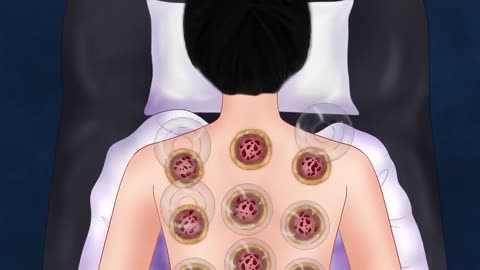 ASMR Cupping therapy and back massage to relieve pain after stress work | 스트레스 작업 후 통증을 완화하는 마사지