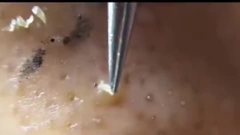 EXTREME PIMPLE POPPING CYST EXPLOSION 2021!!!