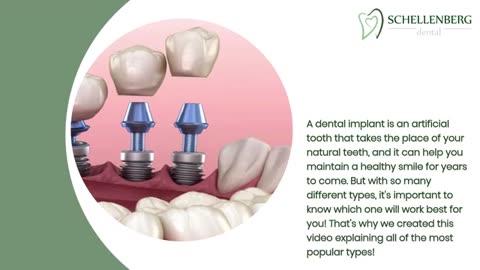 Discovering Dental Implants: Uncover the Best Solution for Your Smile