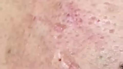 Blackheads & Milia, Big cystic acne blackheads extraction whiteheads Removal Pimple Popping.