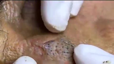 Super Removal Of Deep Blackheads On The Nose