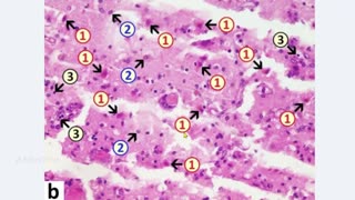 Evidence: Damage to the Brain and Heart Caused by the Vaccine, NOT the Infection - Dr. John Campbell