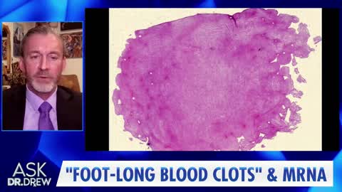 Thick, Fibrous Clots That Don't Easily Degrade