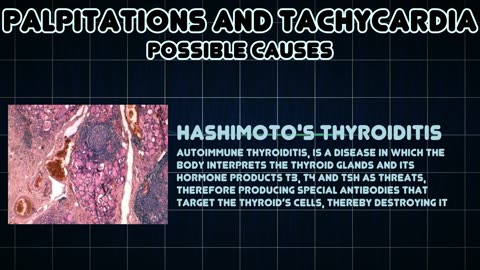 Palpitation and Tachycardia