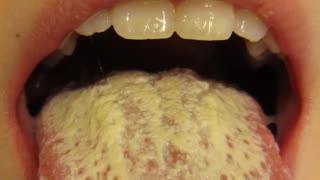 Oral Cavity Diseases