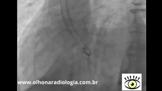 AORTOGRAFIA E VENTRICULOGRAFIA - Olho na Radiologia