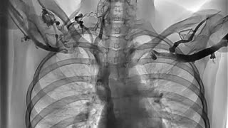 Exploring Venous Thoracic Outlet Syndrome: A Phlebography Study