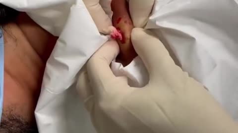 Infected Cyst Drainage