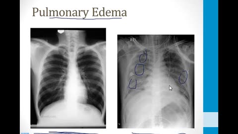 Pulmonary - 3. Other Pulmonary Topics - 9.Chest x-rays