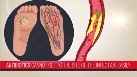 Signs of Diabetic Foot | Prevention and Treatment tips