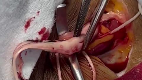 removing one of the strange white fibrous clots