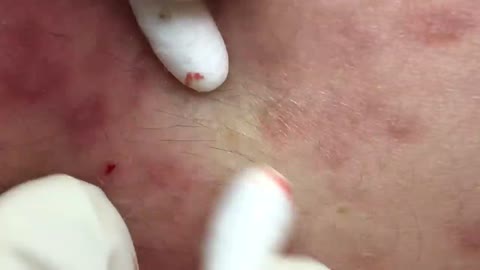 Removing Pimples and Blackheads from the Face, #3
