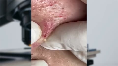 Perfect Extraction of Blackheads on the Lips-Pimple Popping Video 2021